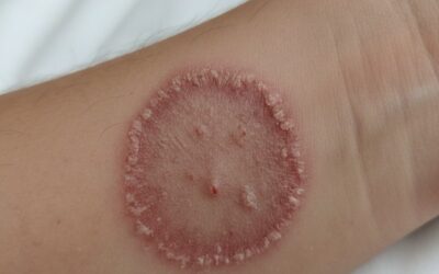 Mycose et peau